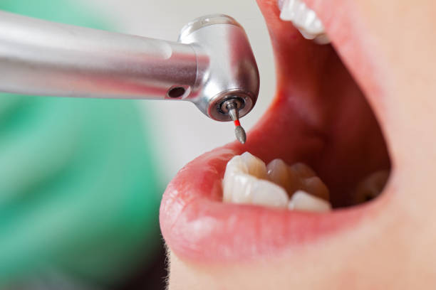 Best Emergency Dentist for Lost Fillings or Crowns in Gas City, IN